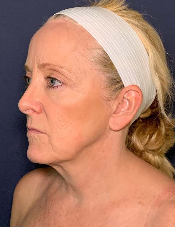 Facelift Before & After Gallery - Patient 104481249 - Image 3