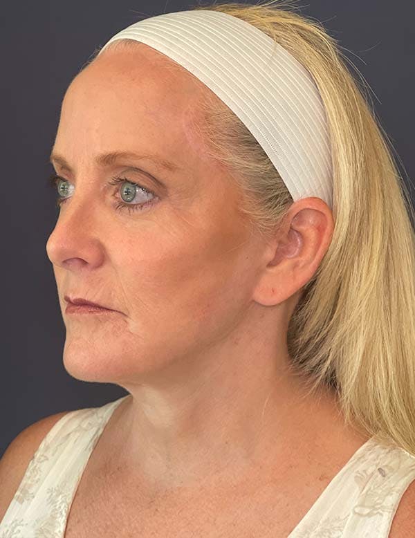 Blepharoplasty (Eyelid Surgery) Before & After Gallery - Patient 104481284 - Image 4