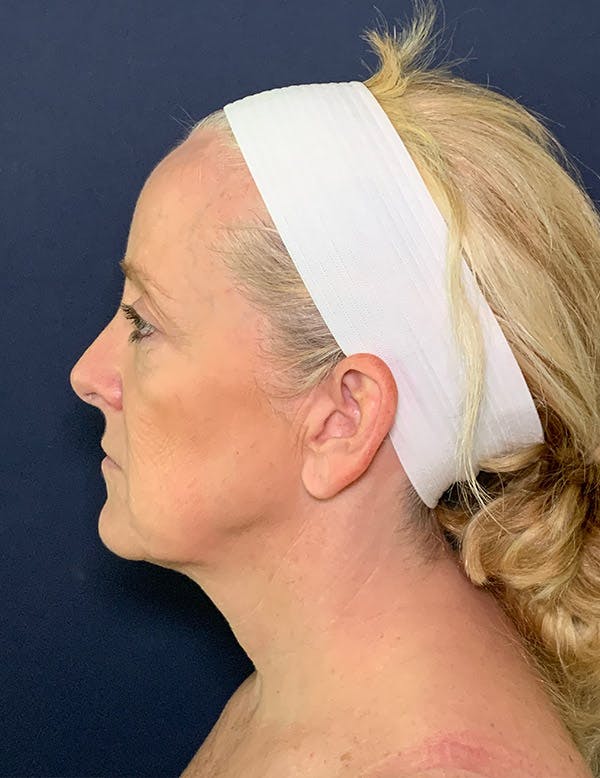 Neck Lift Before & After Gallery - Patient 141112695 - Image 5