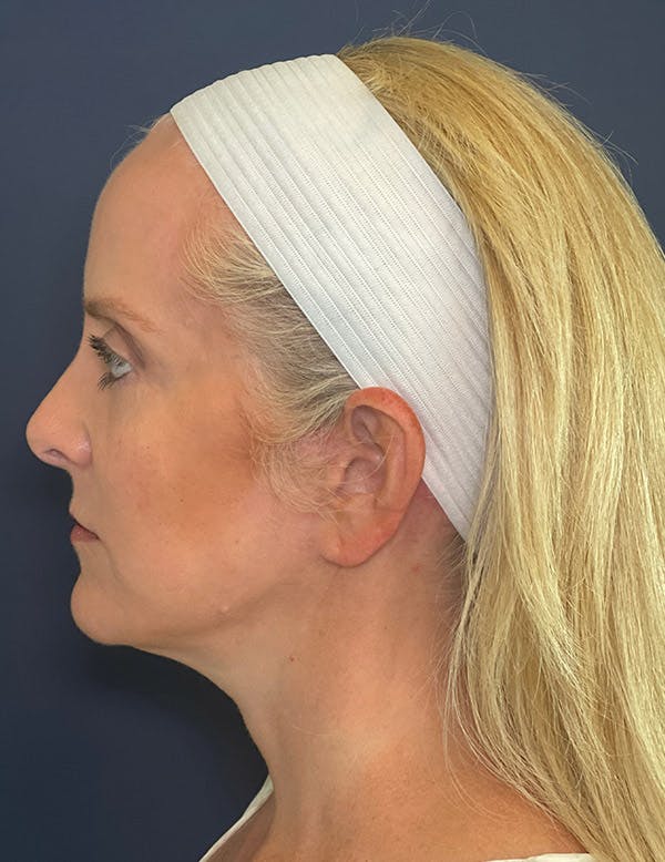 Facelift Before & After Gallery - Patient 104481249 - Image 6