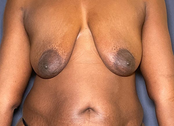 Naturabra™ Mastopexy Before & After Gallery - Patient 104481302 - Image 1