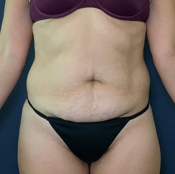 Liposuction Gallery - Patient 117691330 - Image 1
