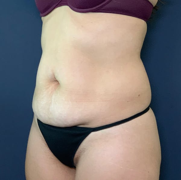 Tummy Tuck (Abdominoplasty) Before & After Gallery - Patient 117691335 - Image 3