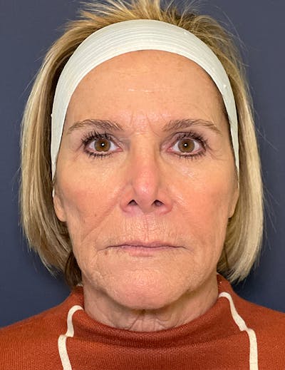 Neck Lift Before & After Gallery - Patient 141112697 - Image 1