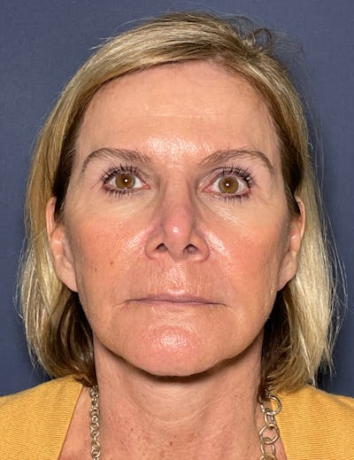 Facelift Before & After Gallery - Patient 117691511 - Image 2