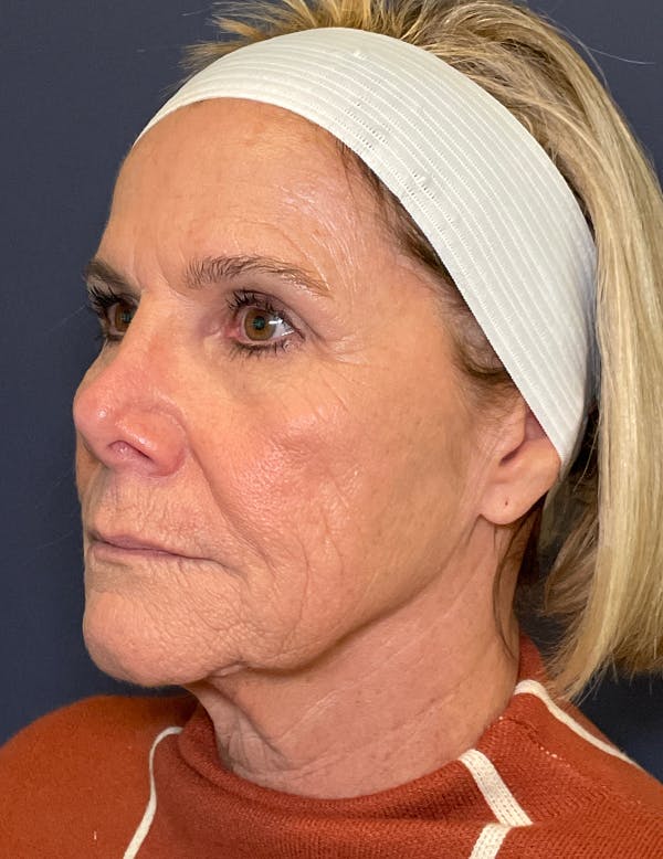 Facelift Before & After Gallery - Patient 117691511 - Image 3