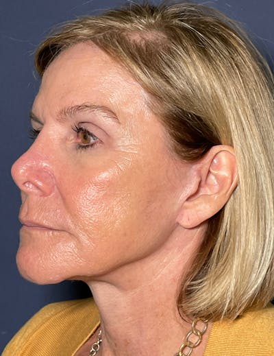 Neck Lift Before & After Gallery - Patient 141112697 - Image 4