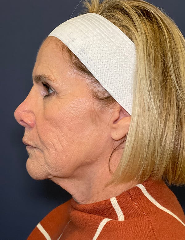 Facelift Before & After Gallery - Patient 117691511 - Image 5