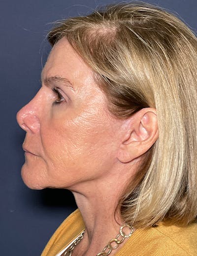 Neck Lift Before & After Gallery - Patient 141112697 - Image 6