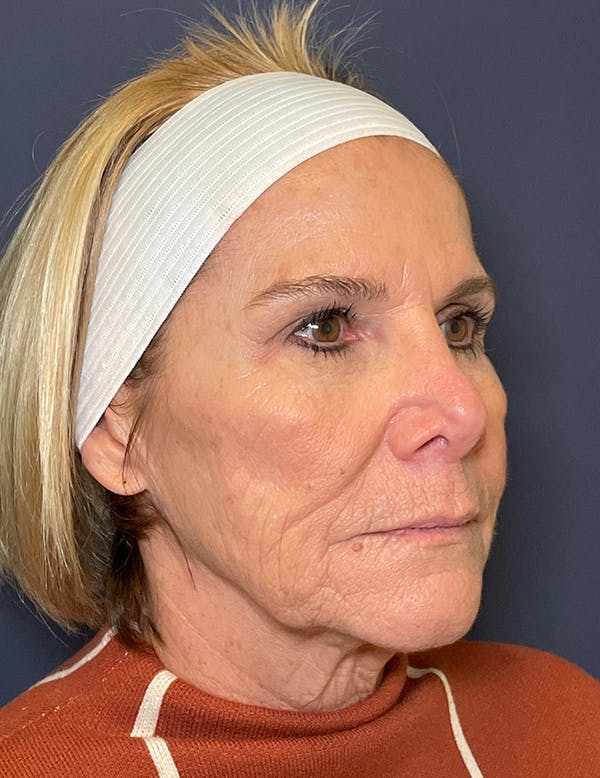 Facelift Before & After Gallery - Patient 117691511 - Image 7