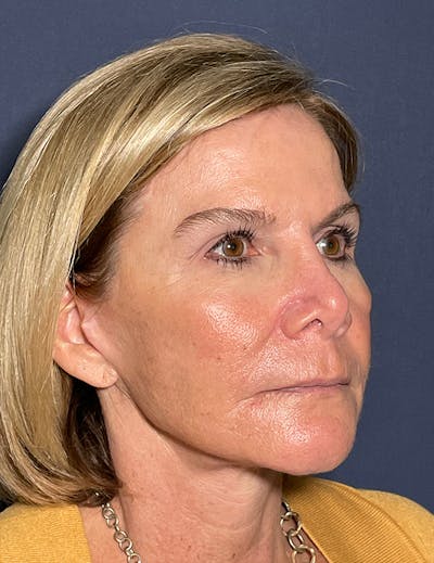 Neck Lift Before & After Gallery - Patient 141112697 - Image 8