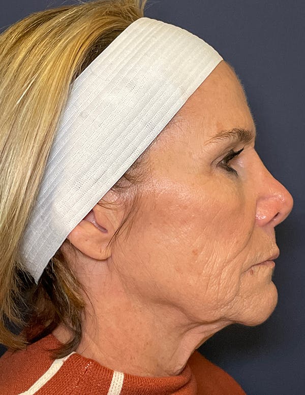 Neck Lift Before & After Gallery - Patient 141112697 - Image 9