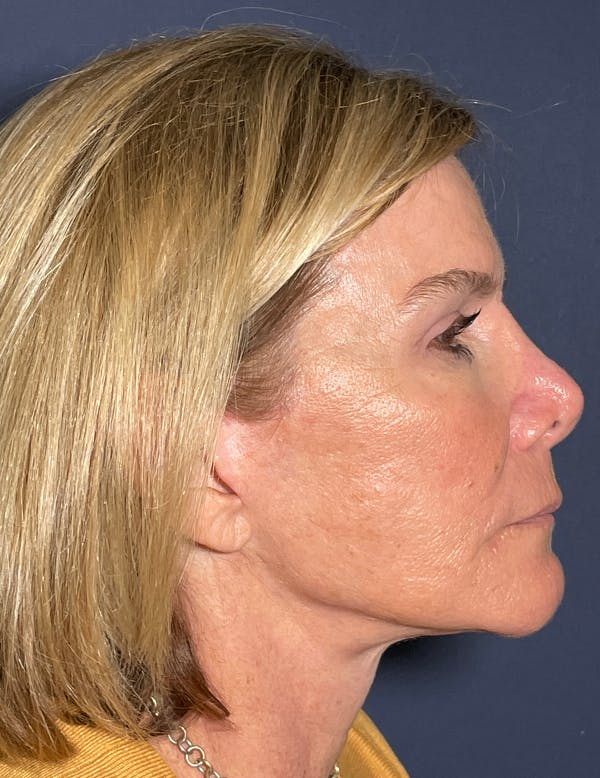 Facelift Before & After Gallery - Patient 117691511 - Image 10
