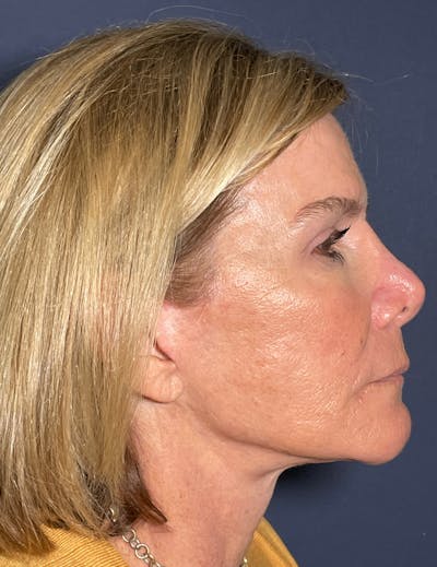 Neck Lift Before & After Gallery - Patient 141112697 - Image 10