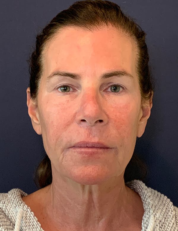 Facelift Before & After Gallery - Patient 117691512 - Image 1