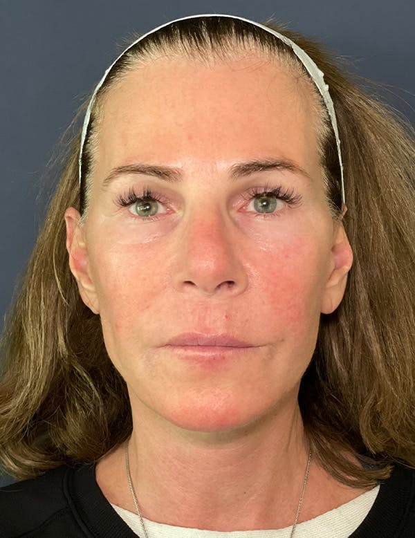 Facelift Before & After Gallery - Patient 117691512 - Image 2