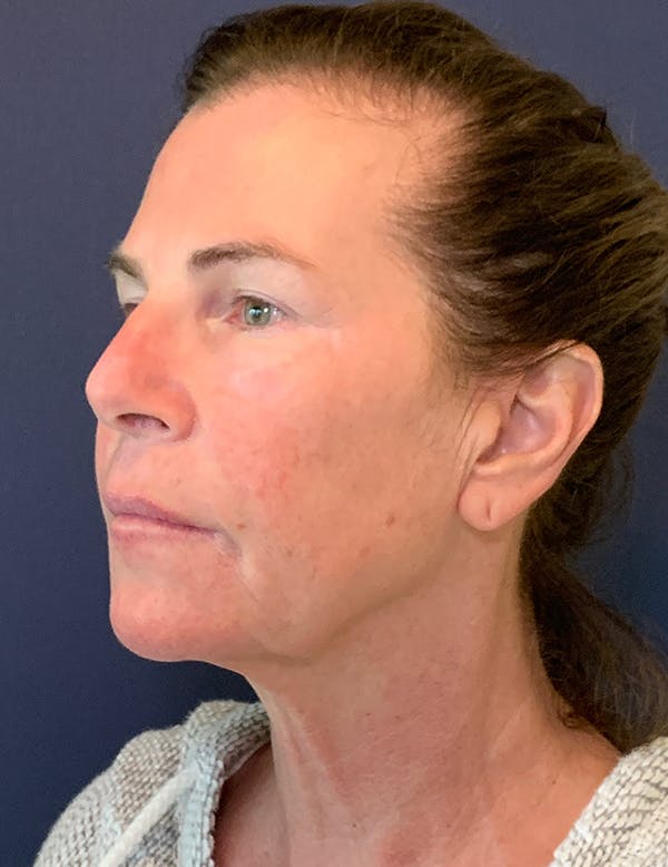 Facelift Before & After Gallery - Patient 117691512 - Image 3