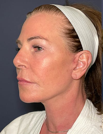 Facelift Before & After Gallery - Patient 117691512 - Image 4