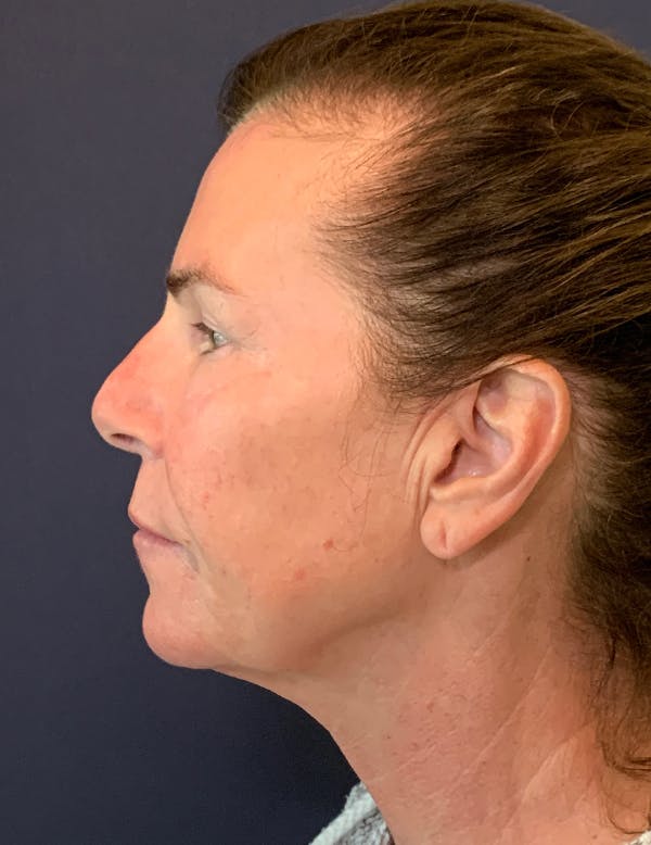 Facelift Before & After Gallery - Patient 117691512 - Image 5