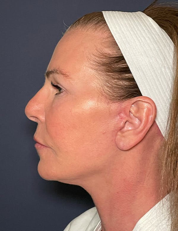 Neck Lift Before & After Gallery - Patient 141112698 - Image 6