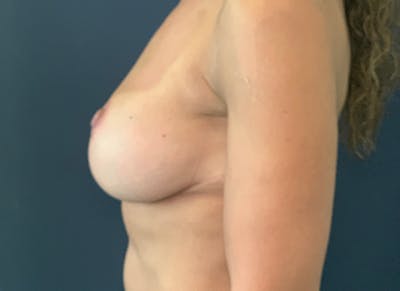 Naturabra™ Mastopexy Before & After Gallery - Patient 117691596 - Image 6