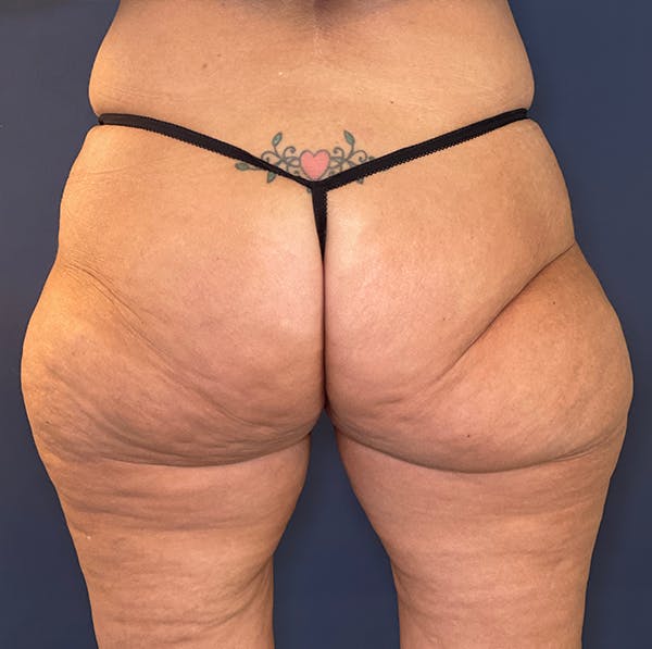 Liposuction Gallery - Patient 117691714 - Image 1