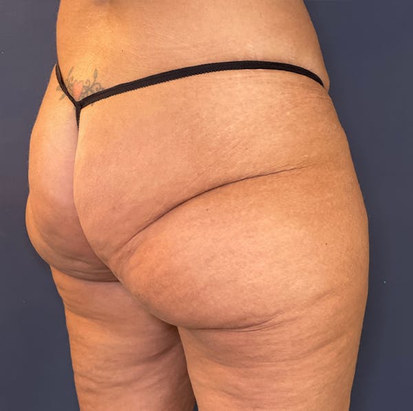 Liposuction Before & After Gallery - Patient 117691714 - Image 3