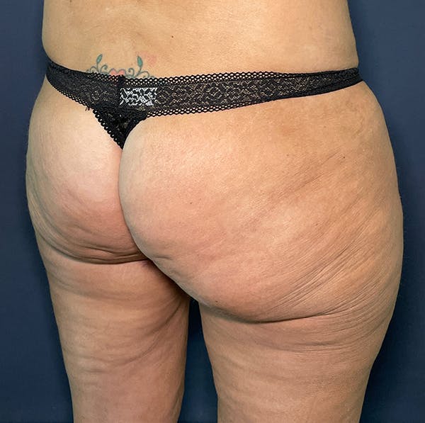 Liposuction Before & After Gallery - Patient 117691714 - Image 4