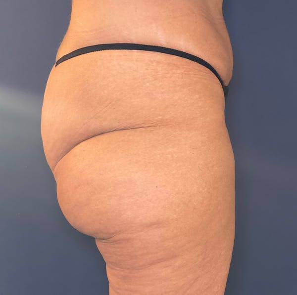 Liposuction Before & After Gallery - Patient 117691714 - Image 5