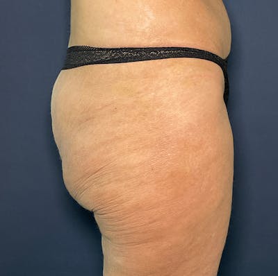 Liposuction Before & After Gallery - Patient 117691714 - Image 6