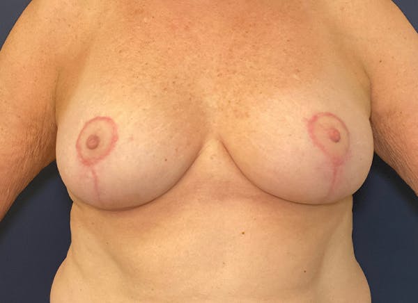 Breast Reduction Before & After Gallery - Patient 117691743 - Image 2
