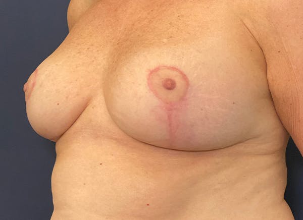 Breast Reduction Before & After Gallery - Patient 117691743 - Image 4