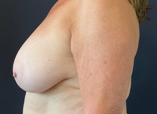 Breast Reduction Before & After Gallery - Patient 117691743 - Image 5