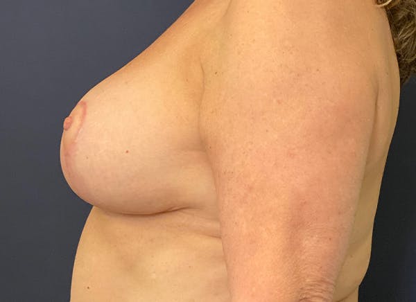 Breast Reduction Before & After Gallery - Patient 117691743 - Image 6