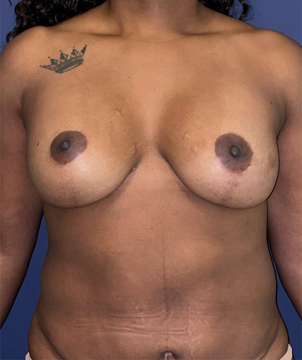 Breast Revision Before & After Gallery - Patient 117691872 - Image 1