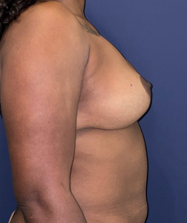 Breast Revision Gallery - Patient 117691872 - Image 3