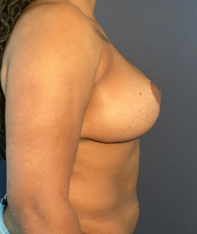 Breast Revision Before & After Gallery - Patient 117691872 - Image 4
