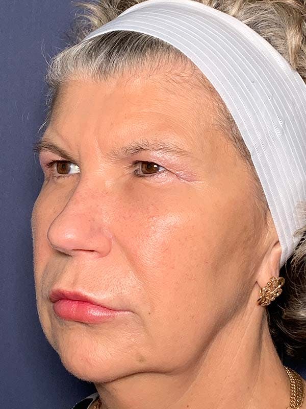 NaturaBrow® Before & After Gallery - Patient 121566466 - Image 5