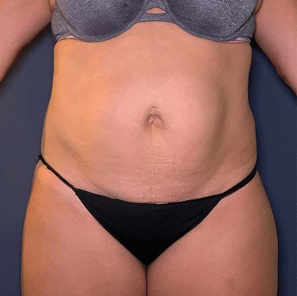 Tummy Tuck (Abdominoplasty) Before & After Gallery - Patient 121566481 - Image 1