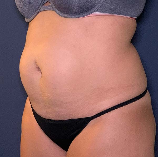 Dr. Alizadeh's patient before Tummy Tuck.