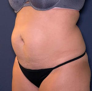 Tummy Tuck Before and After Images