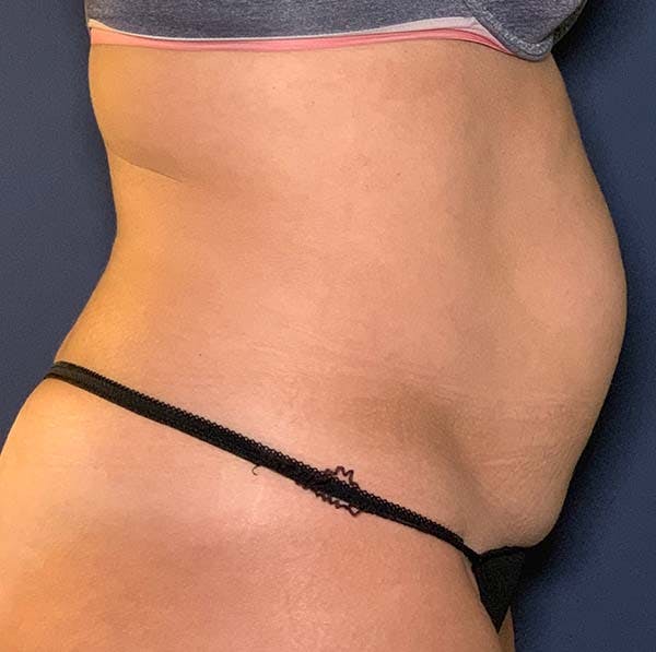 Tummy Tuck (Abdominoplasty) Before & After Gallery - Patient 121566481 - Image 5