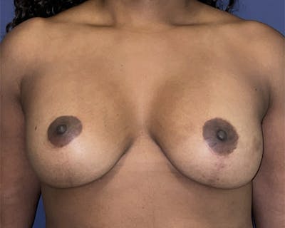 Breast Augmentation Before & After Gallery - Patient 122622932 - Image 1