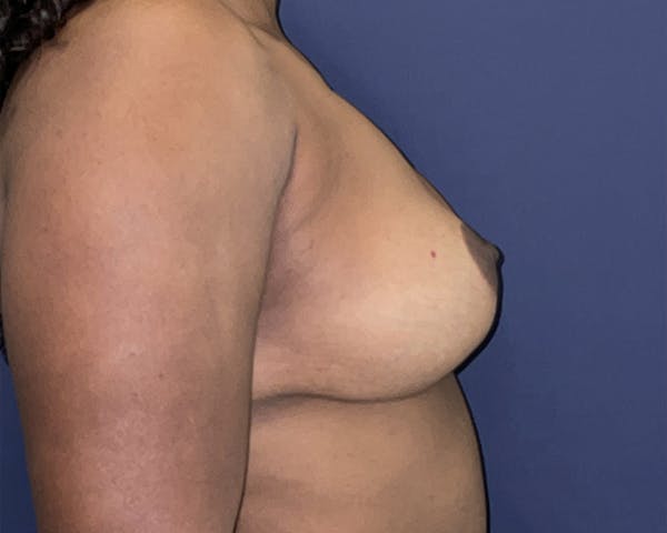 Breast Augmentation Before & After Gallery - Patient 122622932 - Image 3