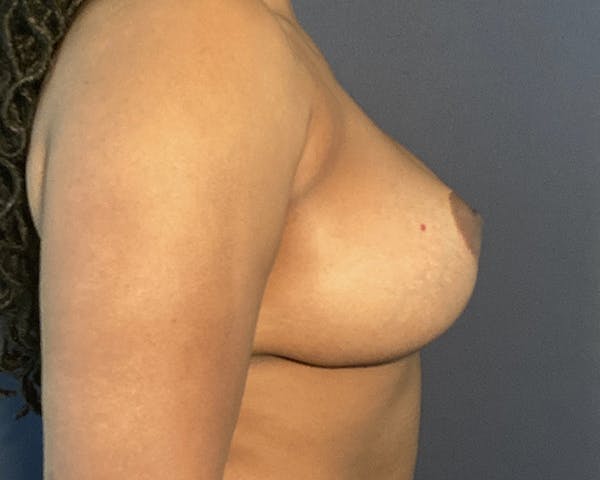 Breast Augmentation Before & After Gallery - Patient 122622932 - Image 4