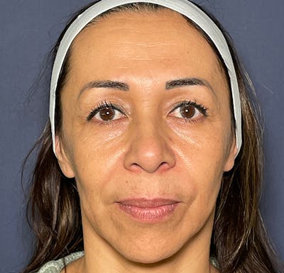 Blepharoplasty (Eyelid Surgery) Before & After Gallery - Patient 123128328 - Image 1