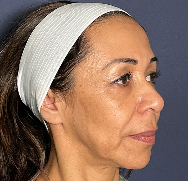 Blepharoplasty (Eyelid Surgery) Before & After Gallery - Patient 123128328 - Image 3