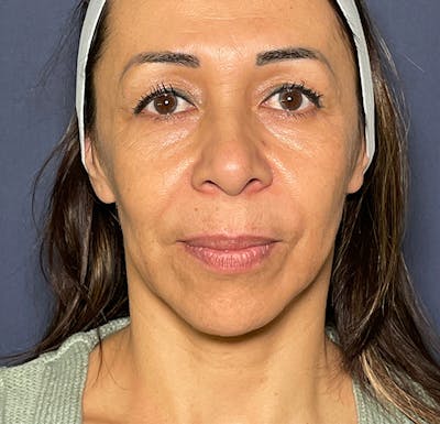 Facelift Before & After Gallery - Patient 141112618 - Image 1