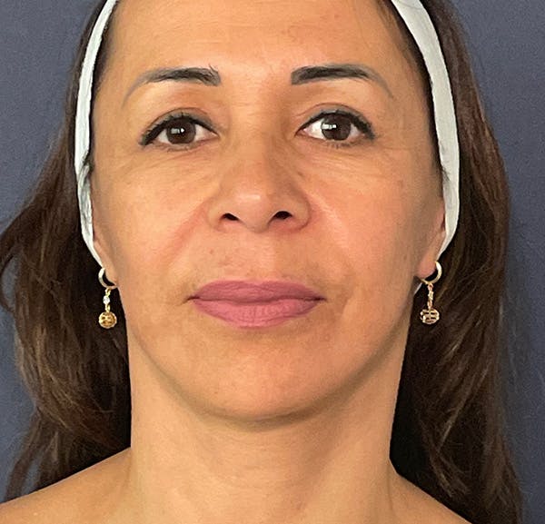 Facelift Before & After Gallery - Patient 141112618 - Image 2
