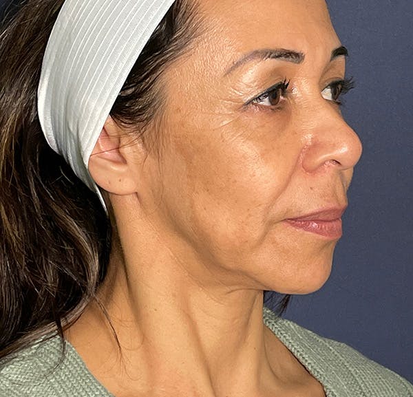 Facelift Before & After Gallery - Patient 141112618 - Image 3